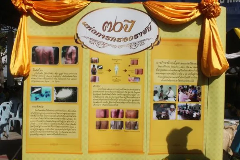 กรมควบคุมโรค ร่วมกับ อสม.ต่างด้าว เร่งค้นหาผู้ป่วยโรคเรื้อนรายใหม่ ป้องกันควบคุมโรคเรื้อนในประชากรต่างด้าว