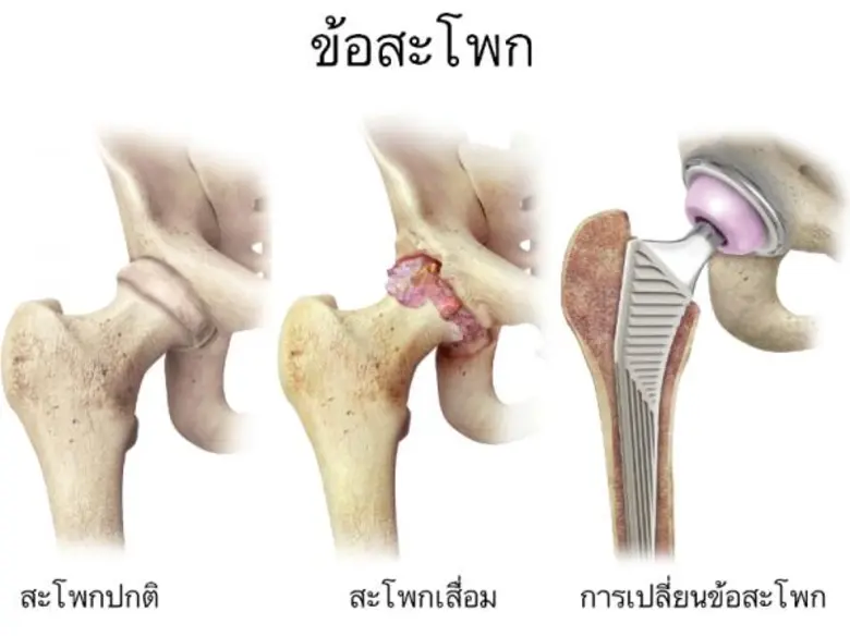 รพ.กรุงเทพเผยความสำเร็จเทคนิคใหม่ในการรักษาโรคกระดูกสะโพกเสื่อมด้วย “การผ่าตัดเปลี่ยนข้อสะโพกแนวใหม่แบบไม่ตัดกล้ามเนื้อ” เจ็บปวดน้อย ฟื้นตัวไว เคลื่อนไหวสะดวก