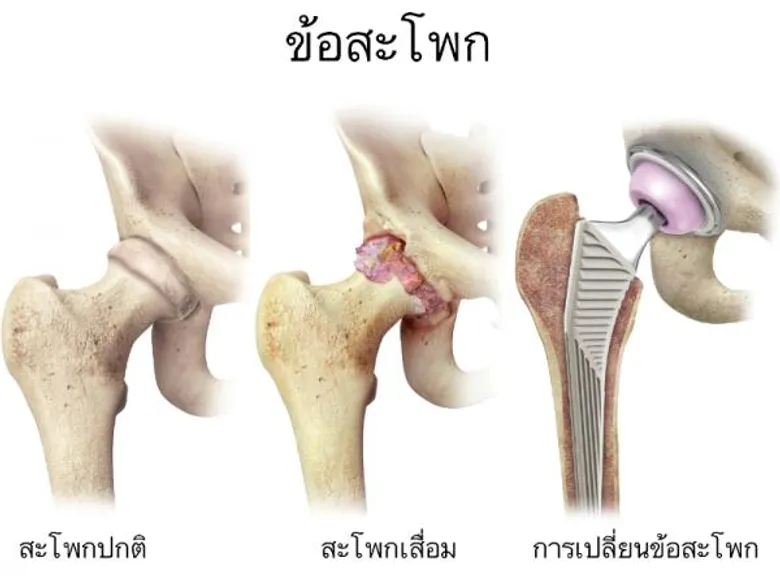รพ.กรุงเทพเผยความสำเร็จเทคนิคใหม่ในการรักษาโรคกระดูกสะโพกเสื่อมด้วย “การผ่าตัดเปลี่ยนข้อสะโพกแนวใหม่แบบไม่ตัดกล้ามเนื้อ” เจ็บปวดน้อย ฟื้นตัวไว เคลื่อนไหวสะดวก