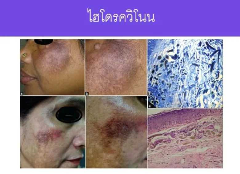 สมาคมแพทย์ผิวหนังฯเตือนประชาชนอยากขาว หยุดเสี่ยง…เลี่ยงซื้อผลิตภัณฑ์ผิวขาว