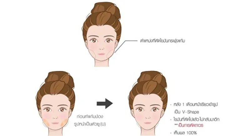 เทรนใหม่มาแรงหน้า V-Shape ทันใจ แค่ตัดไขมันกระพุ้งแก้ม