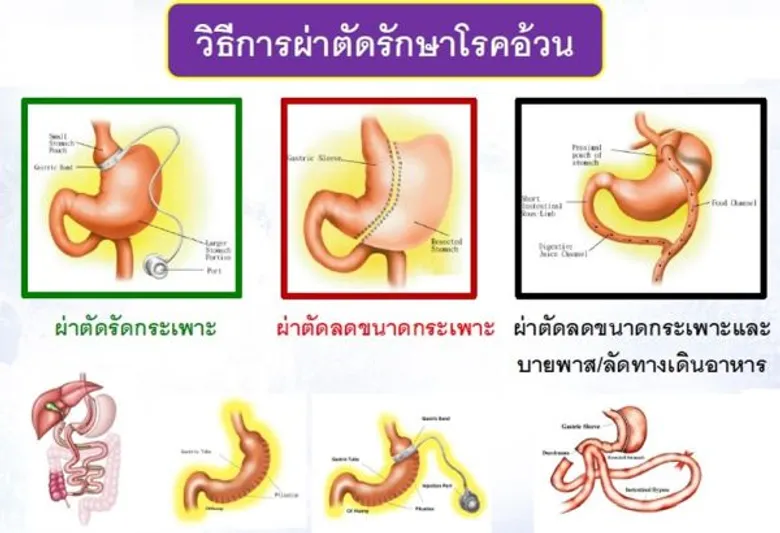 อุบัติการณ์โรคอ้วนและนวัตกรรมการรักษาสมัยใหม่ด้วยวิธีการผ่าตัด