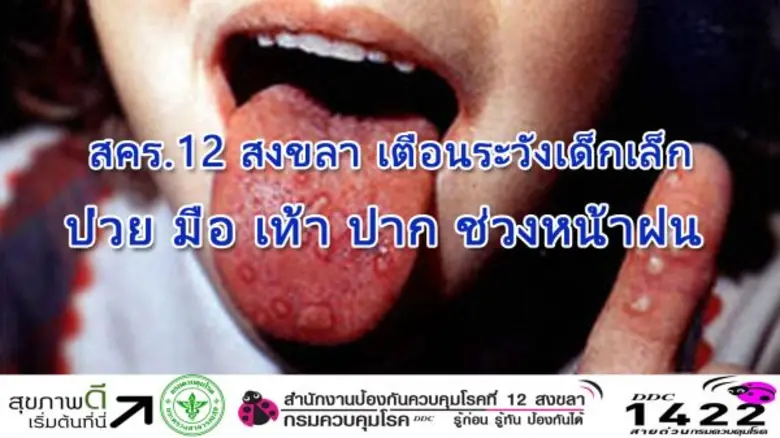 สคร.12 สงขลา เตือนระวังเด็กเล็กป่วยโรค มือ เท้า ปาก ช่วงหน้าฝน