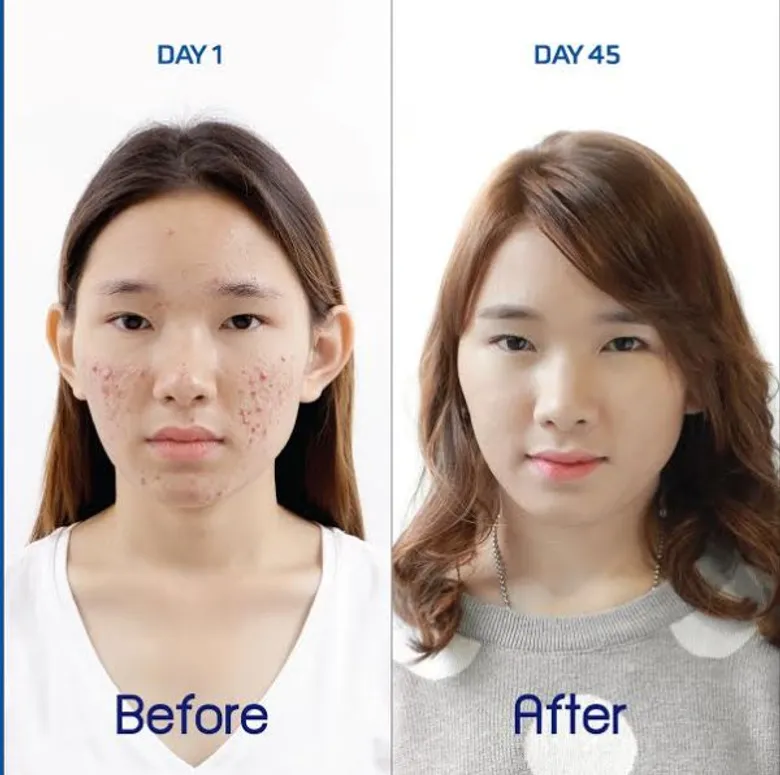 หน้าใส ไม่ต้องพึ่งแอพด้วย E-Lase Plus Program ลบรอยแดง กำจัดรอยดำ แบบอยู่หมัด!