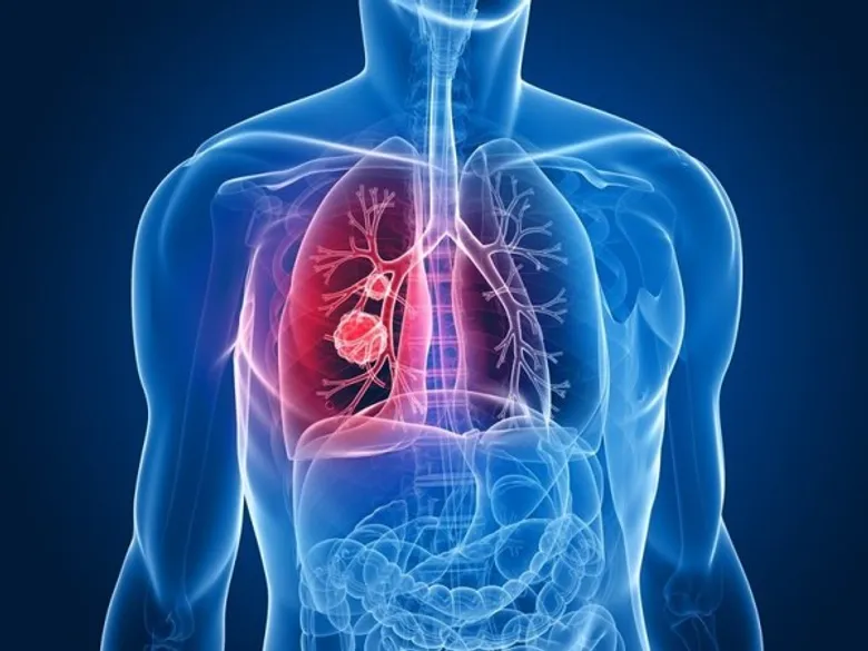 อุบัติการของโรคมะเร็ง incidence and mortality of cancer