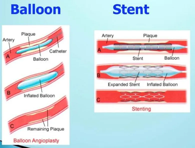 คนอ้วนเสี่ยงเป็นโรคหลอดเลือดหัวใจ ตีบหรือตัน (coronary artery disease)