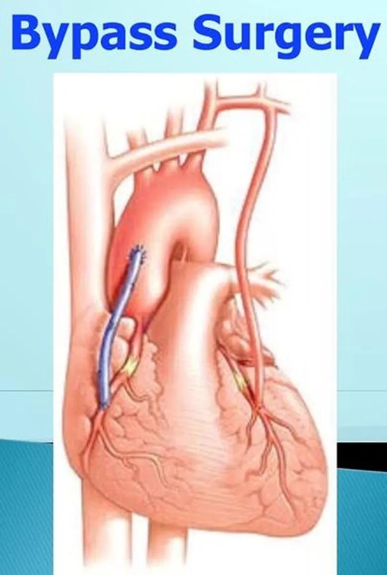 คนอ้วนเสี่ยงเป็นโรคหลอดเลือดหัวใจ ตีบหรือตัน (coronary artery disease)