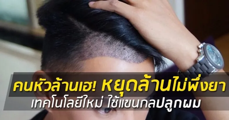 คนหัวล้านเฮ!! หยุดล้านไม่พึ่งยา เทคโนโลยีใหม่ ใช้แขนกลปลูกผม