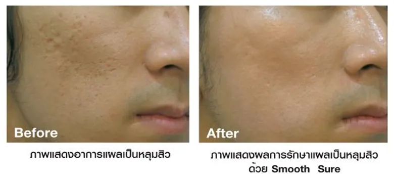 จบปัญหาผิวไม่เรียบ ลดรอยหลุมสิว และ รูขุมขนกว้าง ด้วย Smooth Sure ของ พรเกษมคลินิค