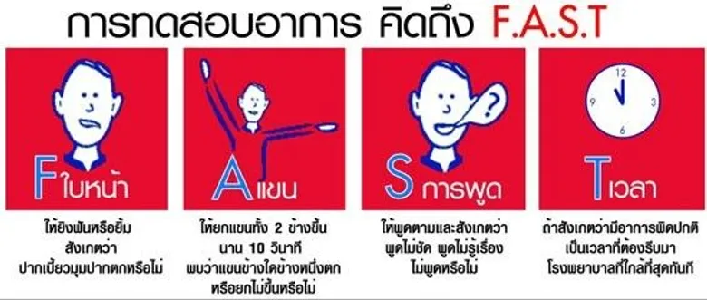 สคร.10 อุบลฯ เผย สัญญาณเสี่ยงโรคหลอดเลือดสมอง “อ่อนแรง แขนขา มึนชาตามัว หน้ามืดปวดหัว ลิ้นรัวเดินเซ”