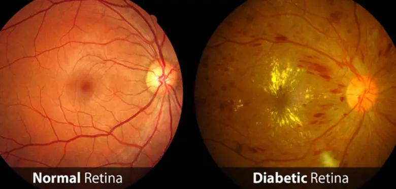 เบาหวานเข้าจอปเบาหวานเข้าจอประสาทตา ( Diabetic Retinopathy )