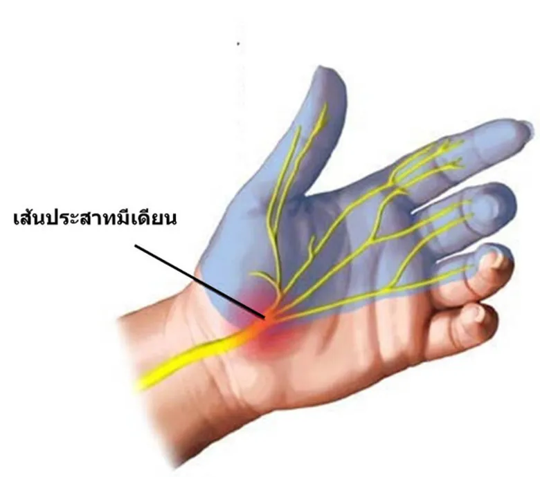 3 โรคทางมือของคนทำงานสุดฮิต ที่แก้ไขได้