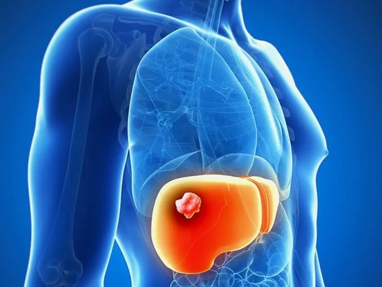 มะเร็งตับ ( Hepatocellular carcinoma ) เป็นเนื้องอก...