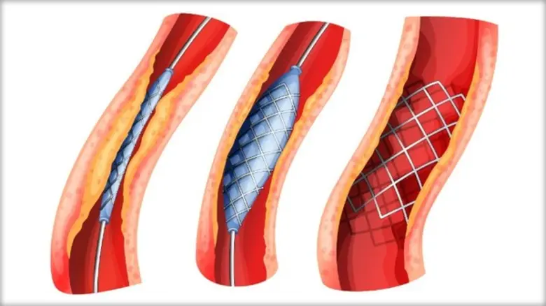โรคหลอดเลือดแดงส่วนปลายอุดตัน หรือ Periph...