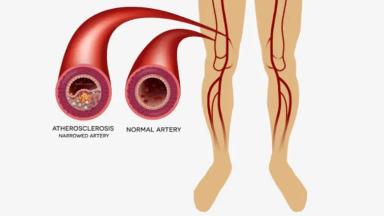 โรคหลอดเลือดแดงเส้นเลือดส่วนปลายอุดตันที่ขา รักษาด้วยการขยายด้วยบอลลูน ( Angioplasty for Peripheral Arterial Disease of the Legs )	