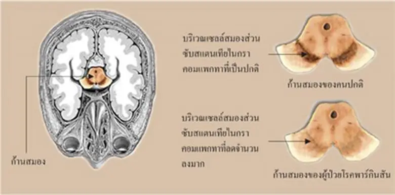 ความรู้โรคพาร์กินสันเพื่อประชาชน รศ.พญ.ศิวาพร จันทร์กระจ่าง ราชวิทยาลัยอายุรแพทย์แห่งประเทศไทย