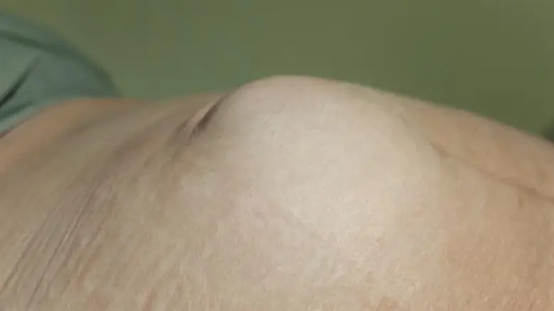 โรคไส้เลื่อน (Hernia) เป็นโรคที่มีความหมา...