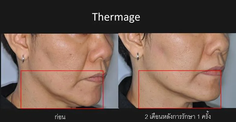 เคล็ดลับการเลือกทำ เทอร์มาจ และไฮฟู่