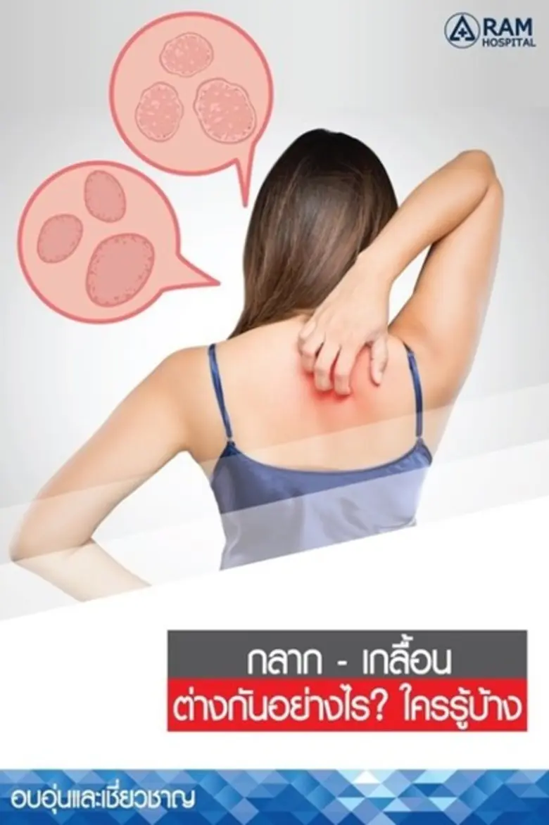 กลาก เกลื้อนต่างกันอย่างไร? ใครรู้บ้าง