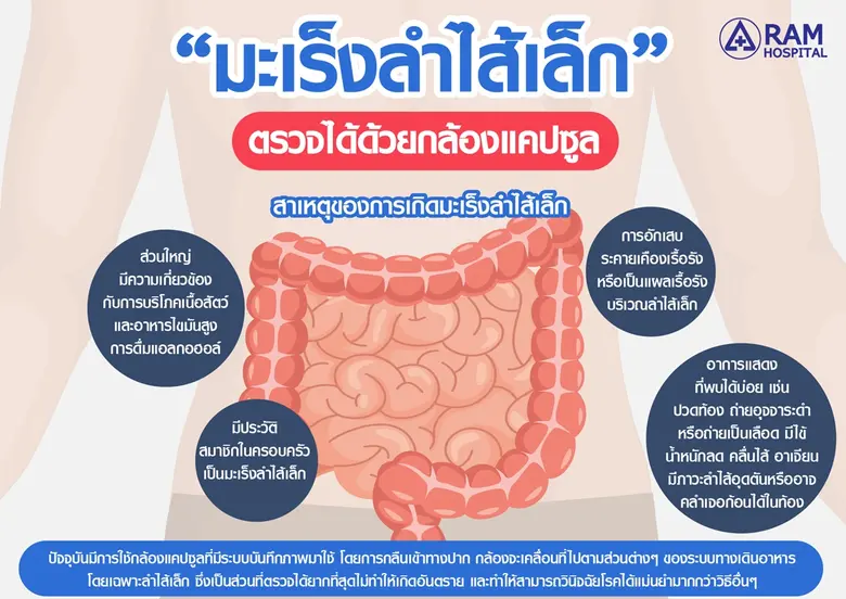 "มะเร็งลำไส้เล็ก" ตรวจได้ด้วยกล้องแคปซูล