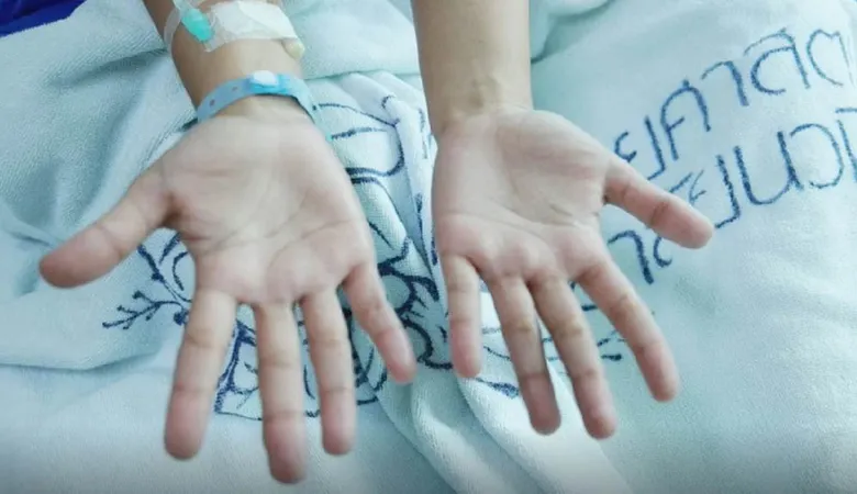 เหงื่อออกมือไม่ใช่สัญญาณของโรคหัวใจ