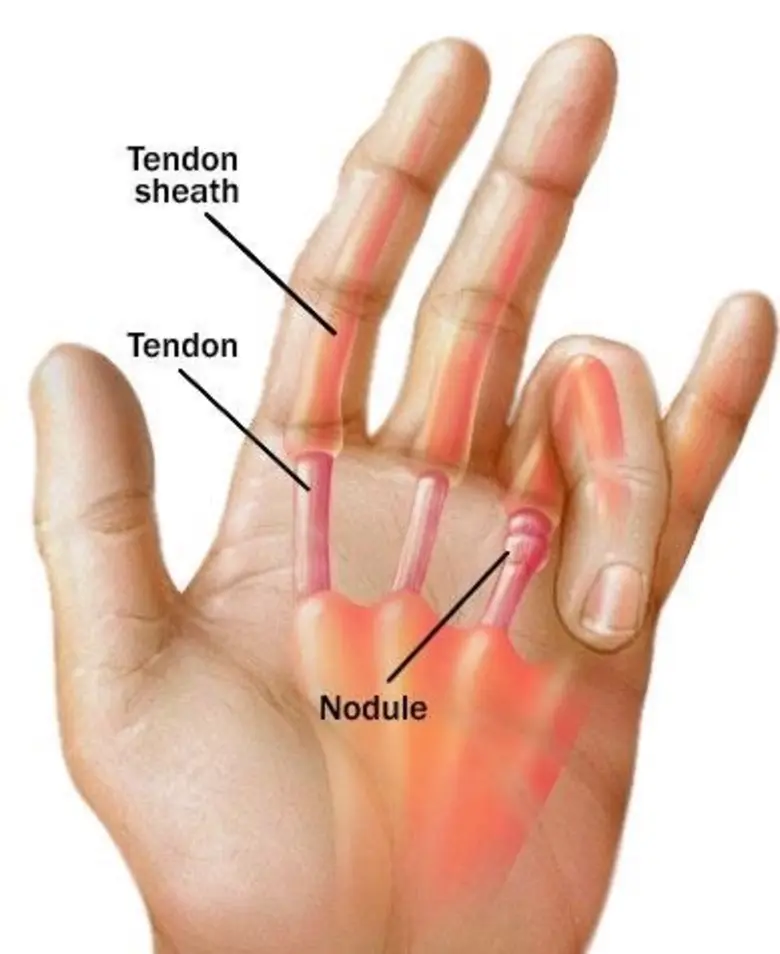 นิ้วล็อค (Trigger finger) เป็นความผิดปกติ...