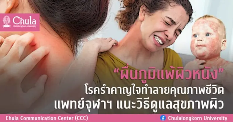 พบผู้ป่วยโรคผื่นภูมิแพ้ผิวหนังเพิ่มขึ้น แพทย์จุฬาฯ ...