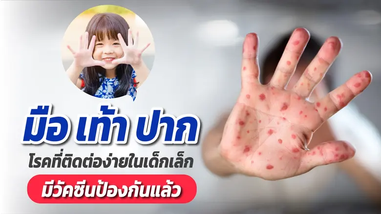 "มือ เท้า ปาก" โรคที่ติดต่อง่ายในเด็กเล็ก...
