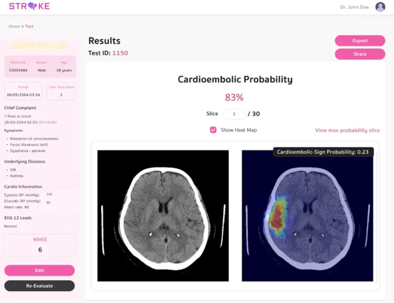 AICute นวัตกรรมจุฬาฯ ประเมินโอกาสเป็น Stroke จากโรคหัวใจ รักษาตรงจุด ลดความเสี่ยงพิการและเสียชีวิต