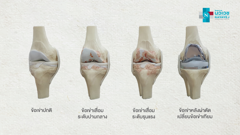 โรคข้อเข่าเสื่อม เป็นโรคที่พบเจอได้มากในก...