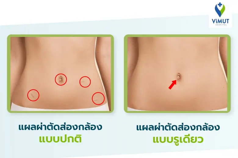 หมดกังวลเรื่องผ่าตัด! ทำความรู้จัก "การผ่าตัดนรีเวชผ่านกล้องแบบรูเดียว" ทางเลือก การรักษาหลากหลายโรคของผู้หญิง