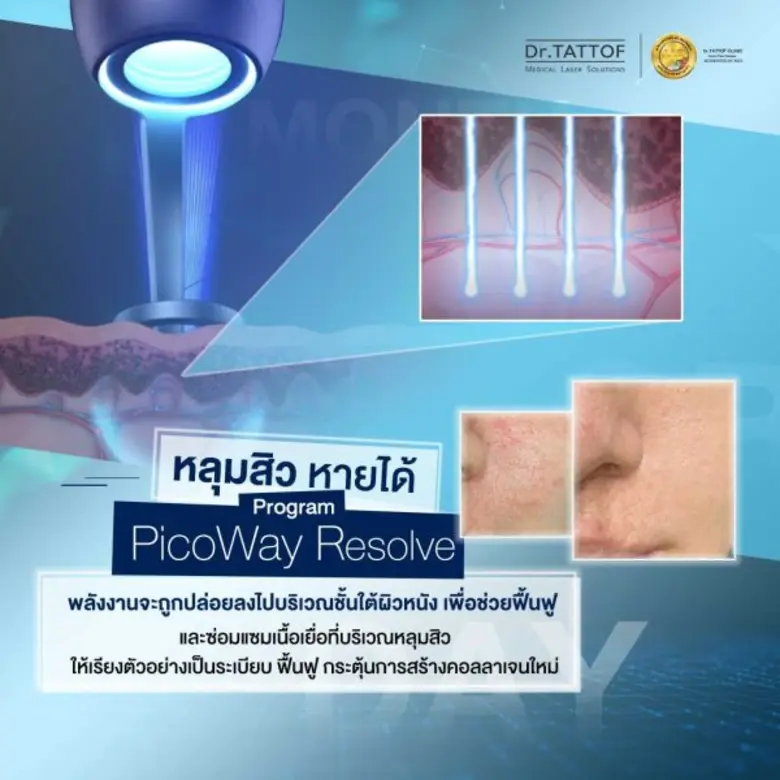Dr.TATTOF ชูนวัตกรรมเลเซอร์ "รักษาหลุมสิว" อ้าแขนรับนักท่องเที่ยว Medical Tourism