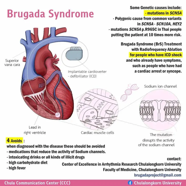 "Brugada Syndrome" A Silent and Deadly Threat to Thai Men