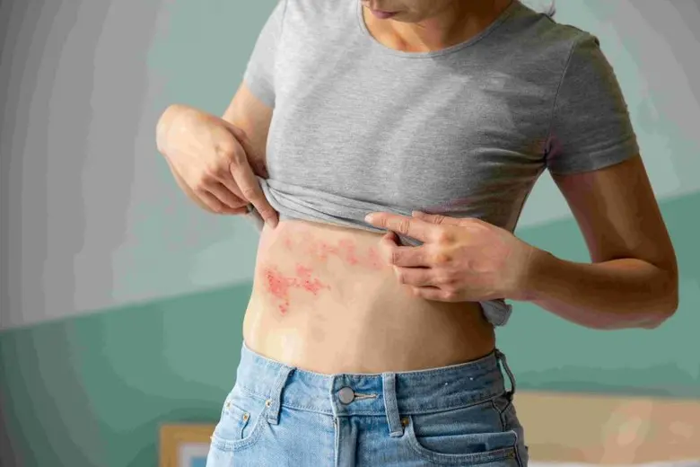 Global GSK survey reveals 86% of adults surveyed significantly underestimate shingles risk and potential severity