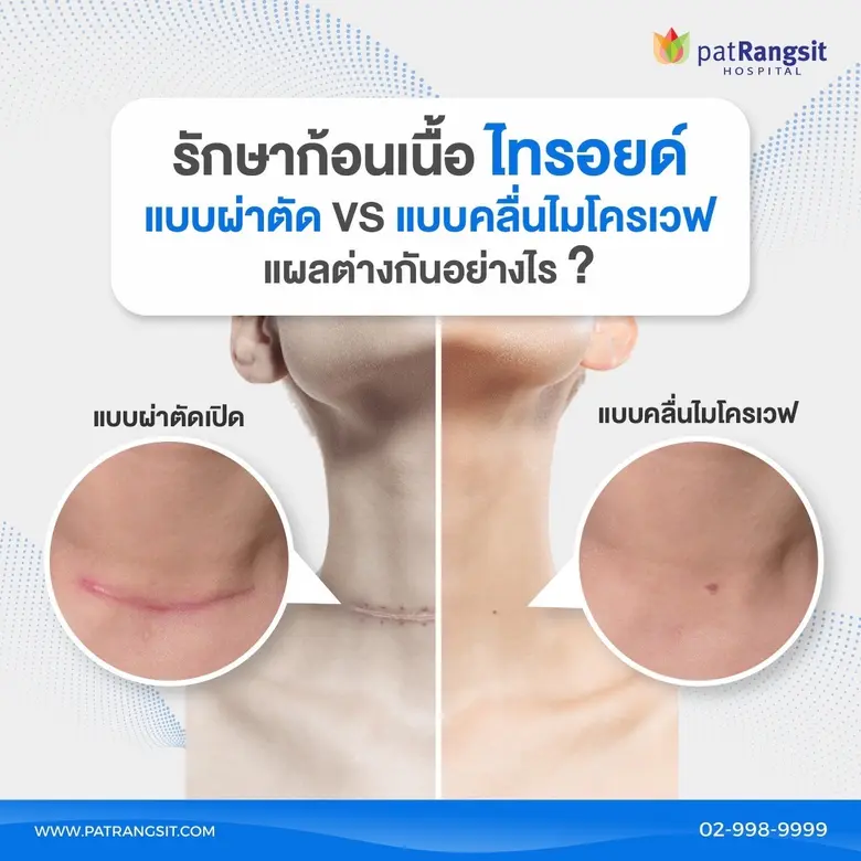 แพทย์รังสิต ผุดเทคนิคทางเลือกใหม่ รักษาก้อนเนื้อไทรอยด์ด้วยคลื่นไมโครเวฟ ไร้แผลเป็นผ่าตัด ลดระยะพักฟื้น ลดภาวะแทรกซ้อน