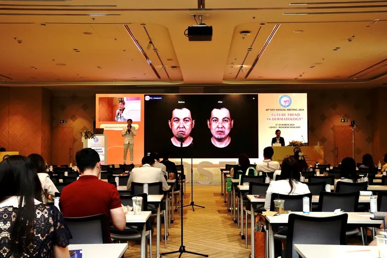 "อาจารย์หมอรัสมิ์ภูมิ" ถ่ายทอดเทคนิค Triangular Facelift ในงานประชุมแพทย์ผิวหนัง ปี 2567