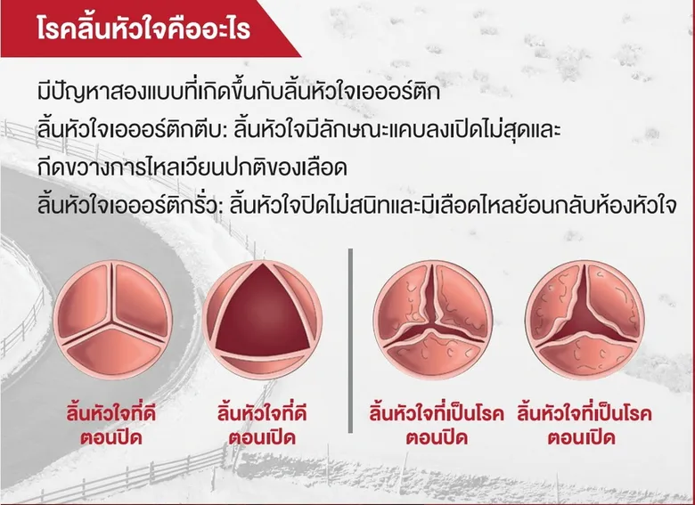 โรคลิ้นหัวใจเอออร์ติก…ภัยร้ายที่อาจมองข้าม รู้ทันสัญญาณอันตราย! ก่อนสายเกินแก้