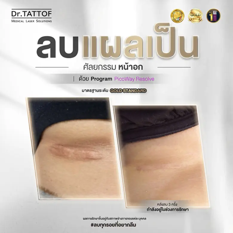 Dr.TATTOF เปิดตัว Scar Clinic ครบวงจร ตอกย้ำความเชี่ยวชาญด้านการรักษาแผลเป็น