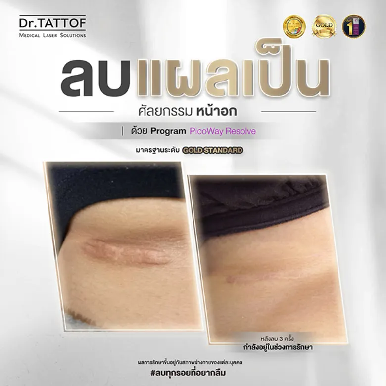 Dr.TATTOF เปิดตัว Scar Clinic ครบวงจร ตอกย้ำความเชี่ยวชาญด้านการรักษาแผลเป็น