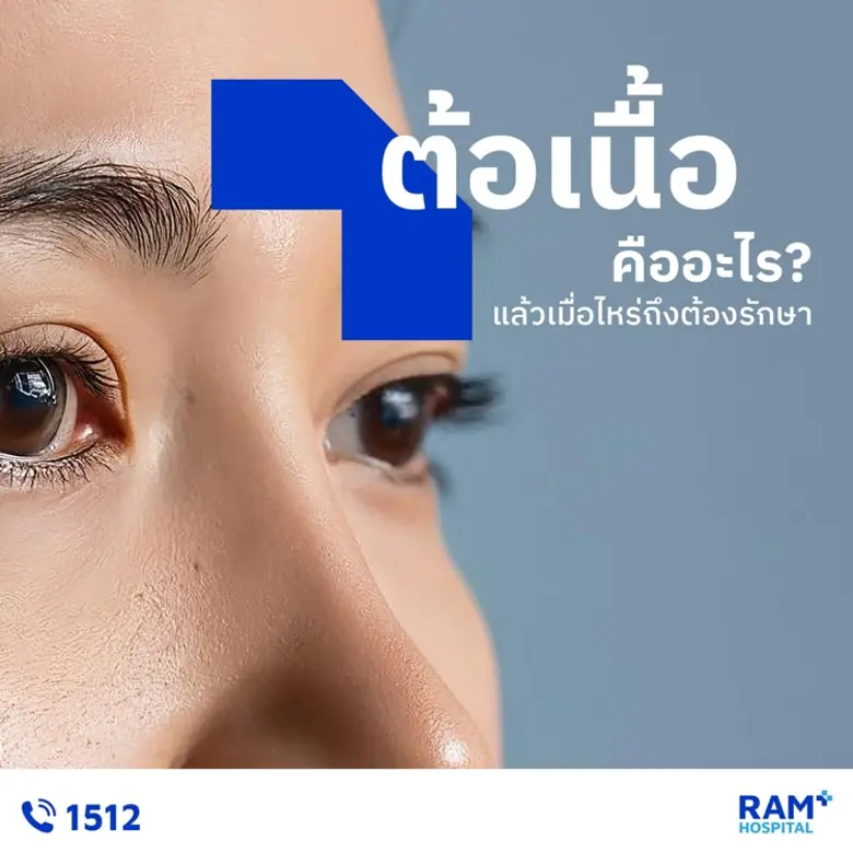 ต้อเนื้อ คือภาวะที่เยื่อบุตาตรงบริเวณตาขาวเกิดการหน...
