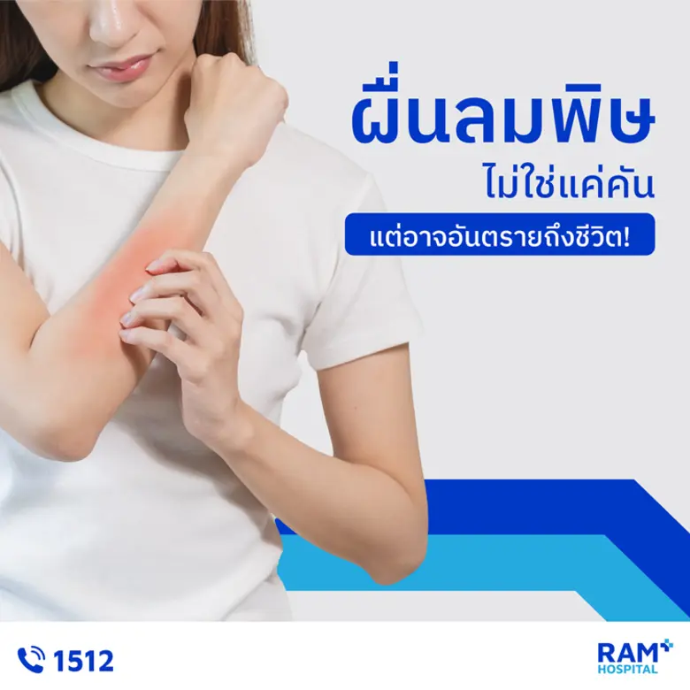 ผื่นลมพิษ เป็นอาการทางผิวหนังที่พบได้บ่อย...