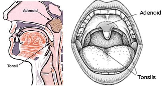 เด็กนอนกรนจากต่อมทอนซิล (Tonsil) และต่อมอะดีนอยด์ (Adenoid)