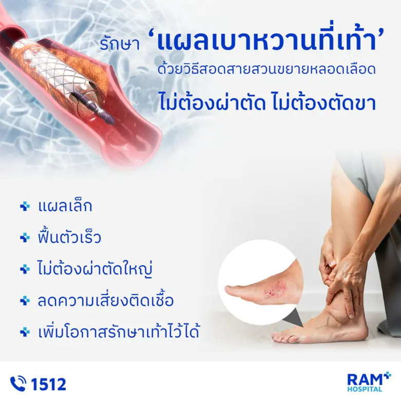 รักษา "แผลเบาหวานที่เท้า" ด้วยวิธีสอดสายส...