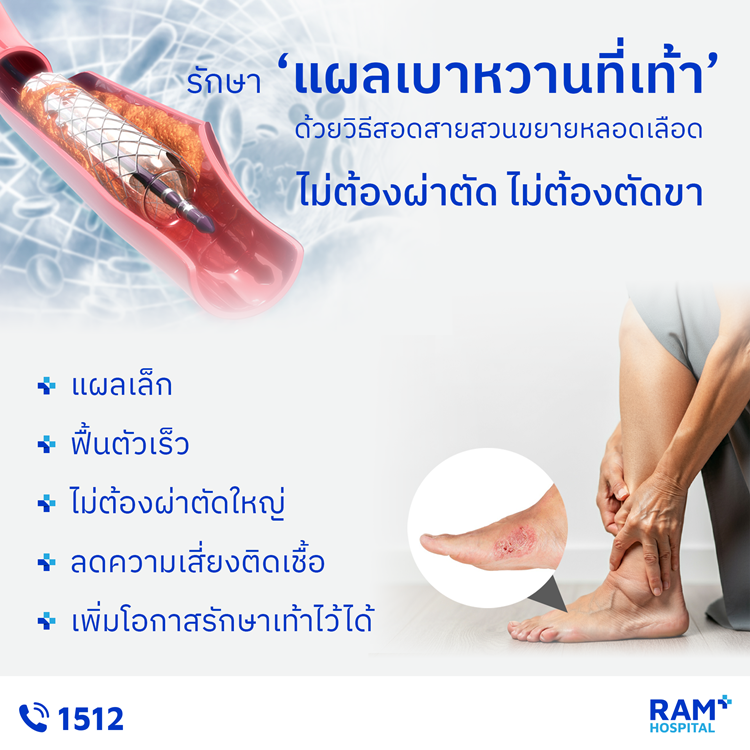 รักษา "แผลเบาหวานที่เท้า" ด้วยวิธีสอดสายส...