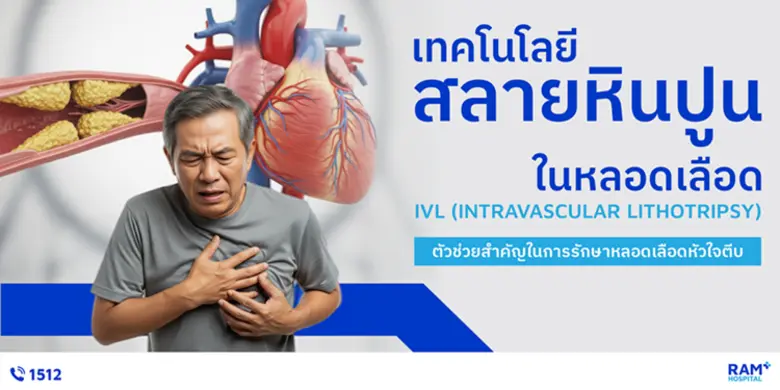 IVL เทคโนโลยีสลายหินปูนในหลอดเลือด ตัวช่ว...