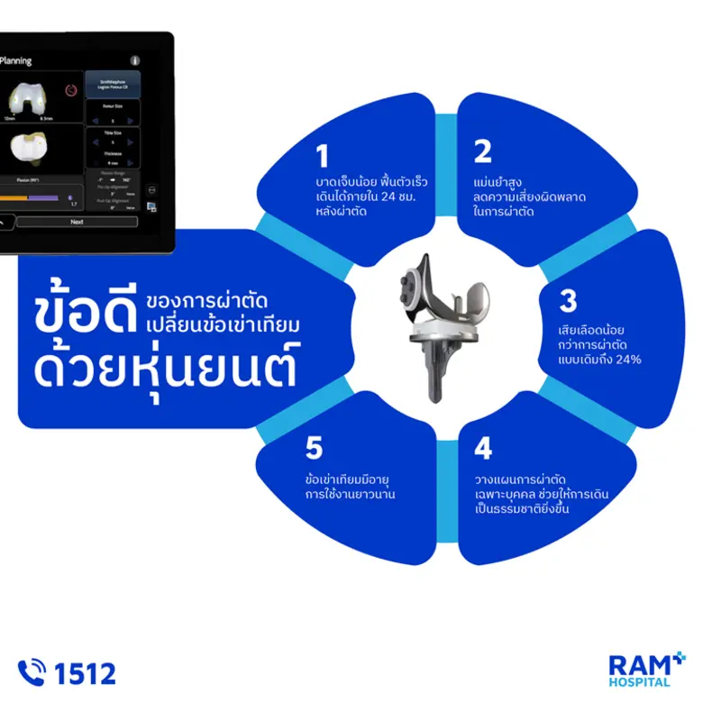 ผ่าตัดเปลี่ยนข้อเข่าเทียม ด้วยหุ่นยนต์ช่วยผ่าตัด ดีอย่างไร?..