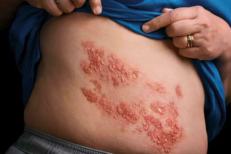 สัปดาห์รณรงค์ป้องกันโรคงูสวัดโลกประจำปี 2...