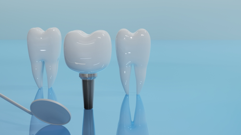 การทำรากฟันเทียมเป็นทางเลือกยอดนิยมสำหรับ...