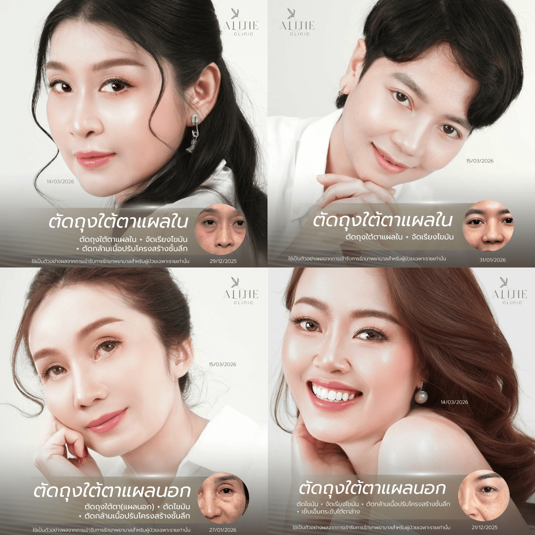 ผ่าตัดถุงใต้ตาอันตรายไหม? ไขข้อสงสัยโดยแพทย์จาก ALINE Clinic