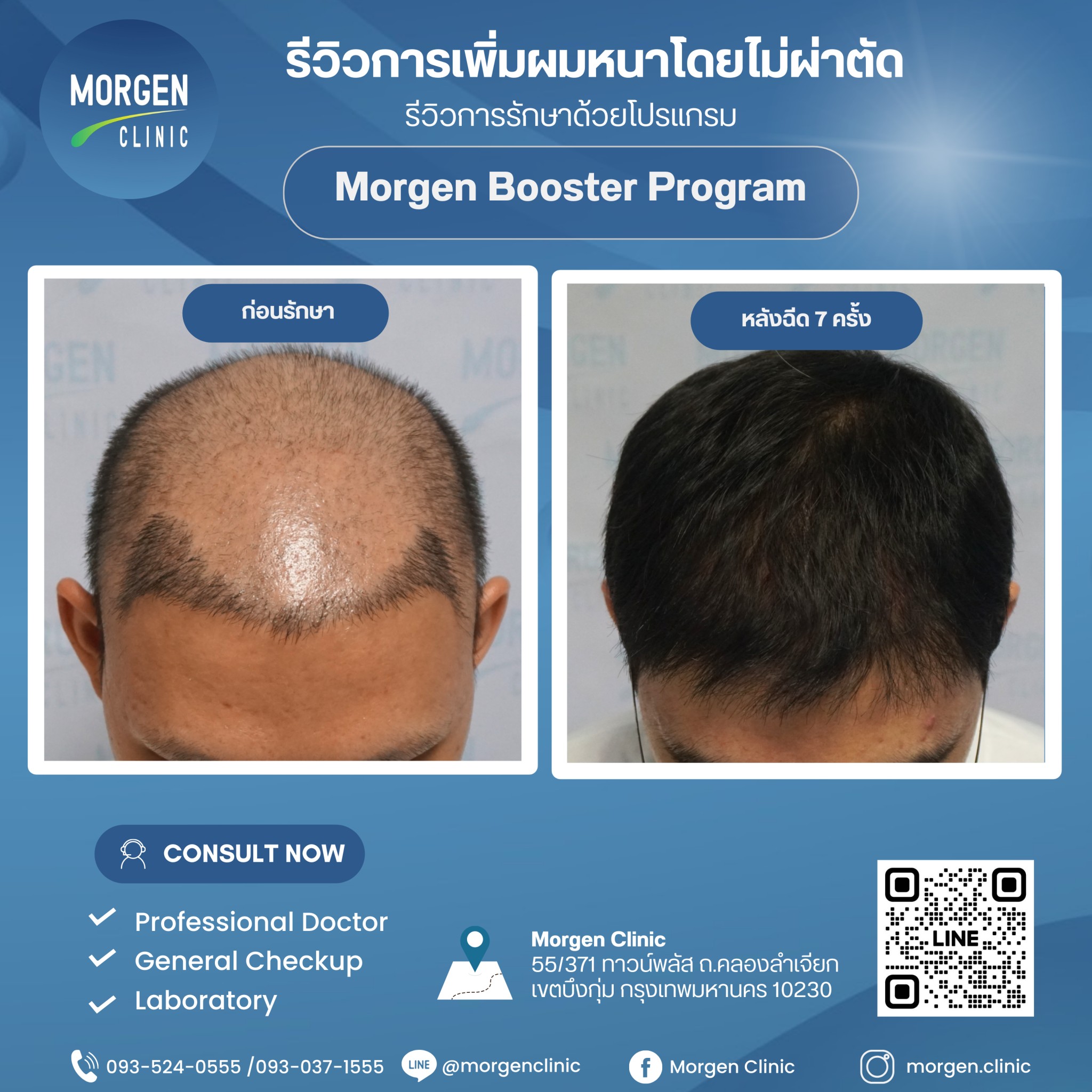 มอเก้นคลินิก ฉลองครบรอบ 5 ปี เปิดตัวโปรแกรมปลูกผมโดยไม่ต้องผ่าตัด พร้อมมอบส่วนลดพิเศษถึง 30%